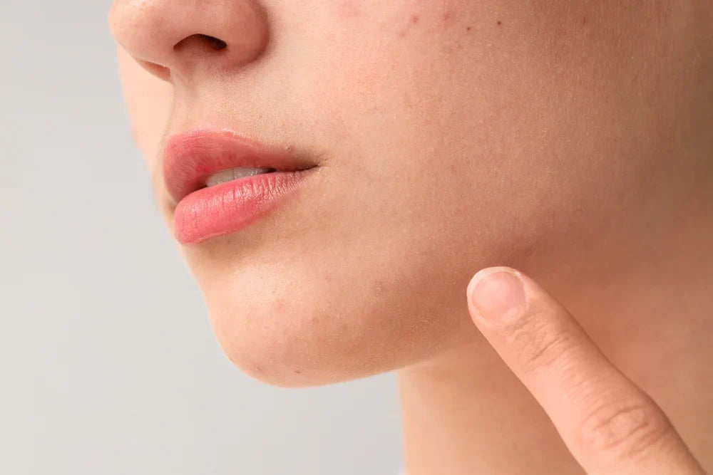 A close-up of a person pointing to their chin, highlighting a small pimple or acne spot on their skin.